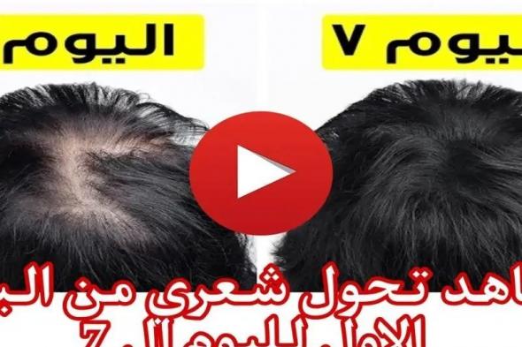 حل مشكلة سقوط الشعر عند الرجال والسيدات نهائيًا والنتيجة مدهشة بعد مرور 7 يوم