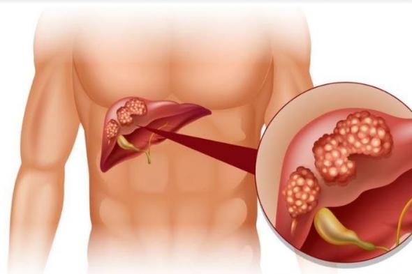 4 علامات تكشف الإصابة بأمراض الكبد.. احذرها